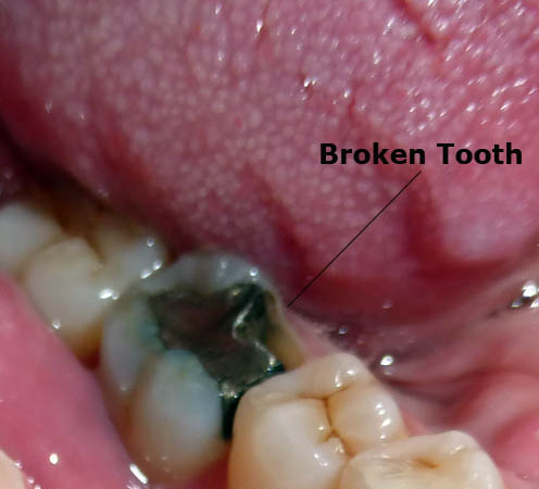 Billy's broken tooth